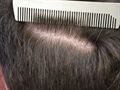 Hair Restoration
